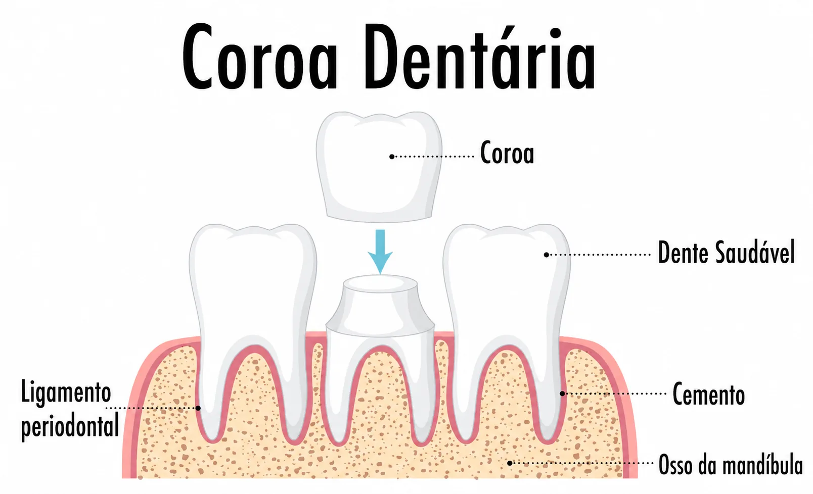 Coroa dentária sobre o dente