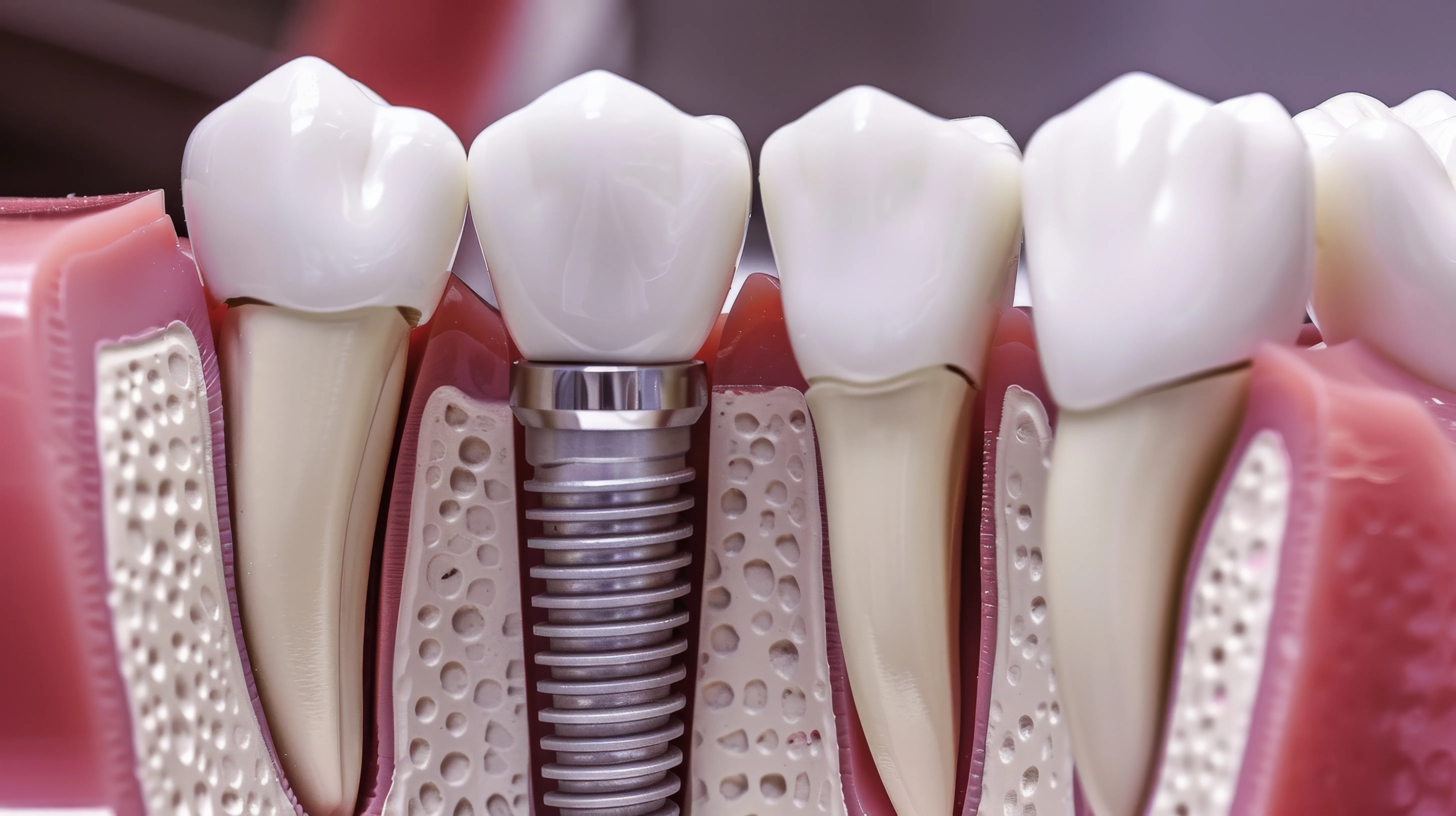 Cimentação definitiva de coroa dentária em Passos-MG