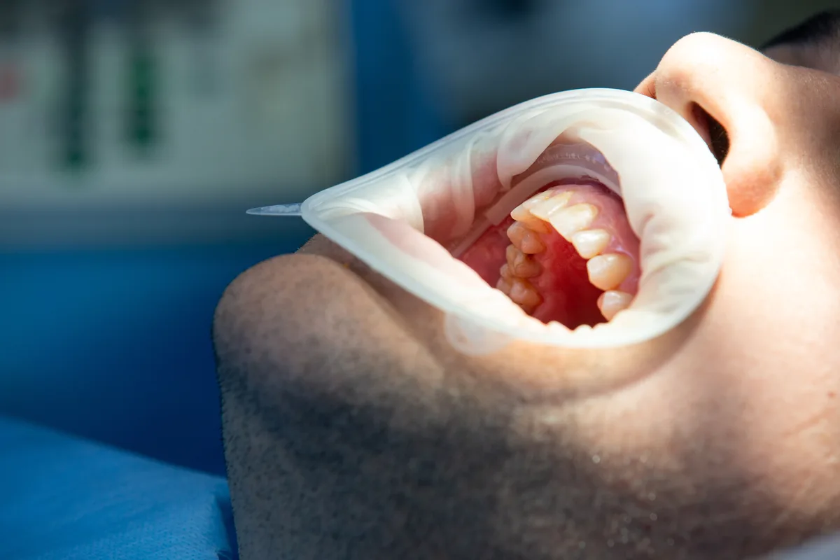 Extração simples de dente em Passos-MG