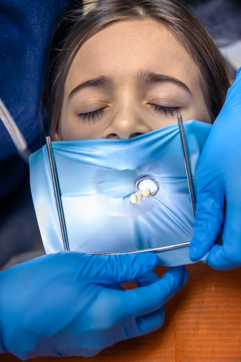 Procedimento de extração de dente com anestesia local em Passos-MG
