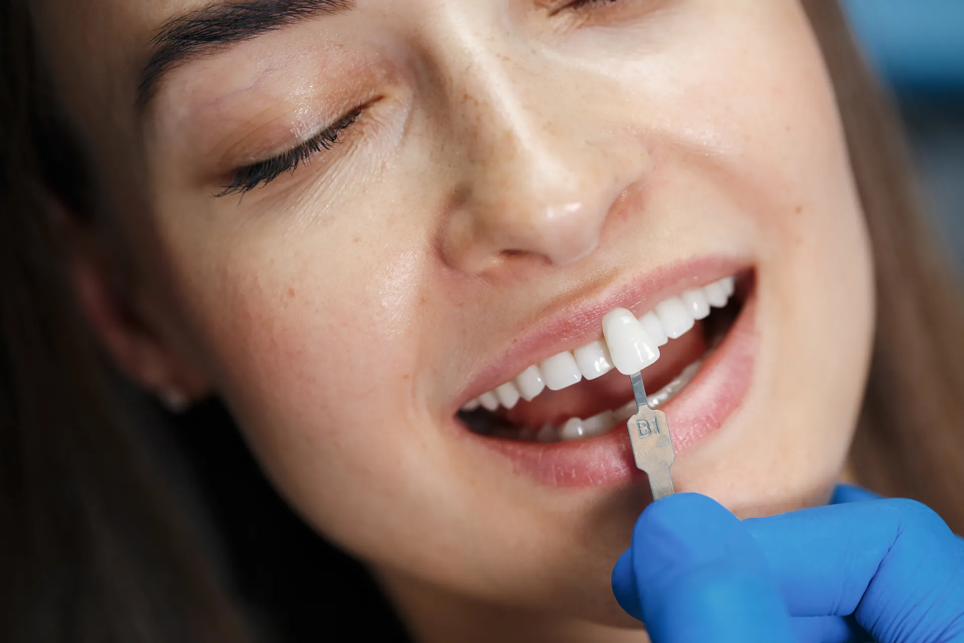 Facetas dentárias em Passos-MG