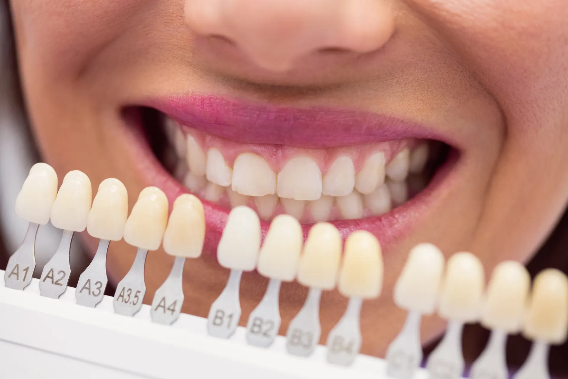 Lente de contato dental sobre os dentes