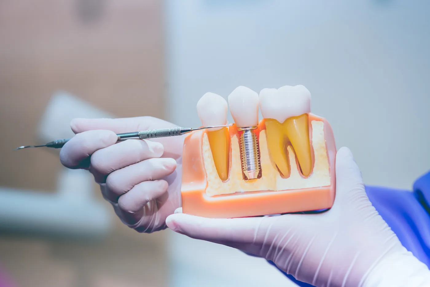 Implante dentário em Passos-MG