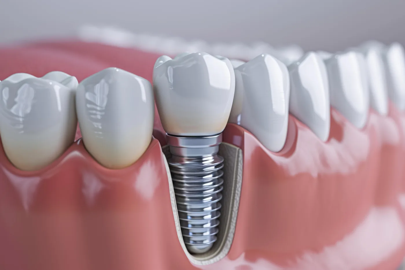 Planejamento individualizado do implante dentário