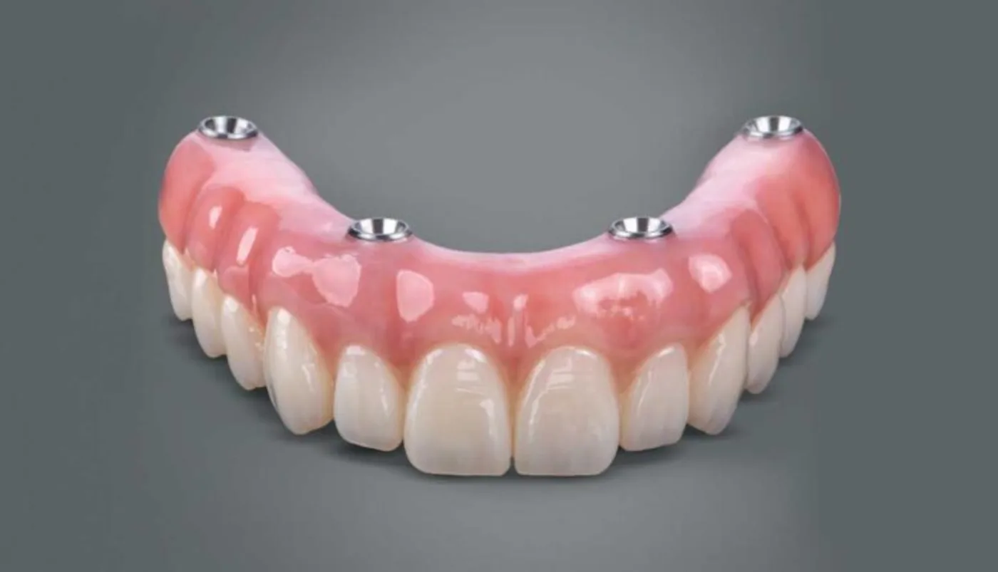 Prótese protocolo All-on-4 com 4 implantes em arcada superior