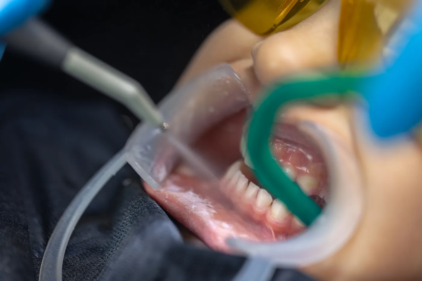 Remoção de tártaro em consultório odontológico