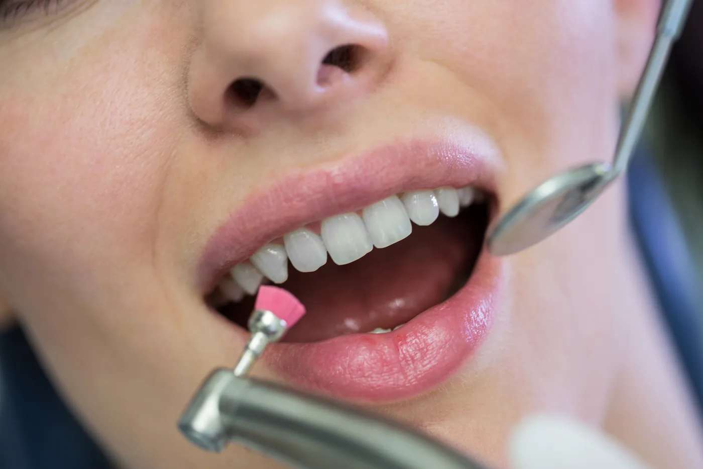 Limpeza dental profissional com taça profilática em Passos-MG