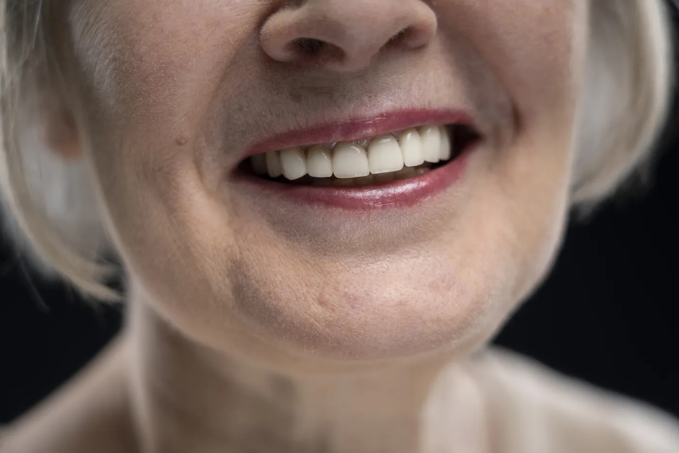 Sorriso natural após reabilitação com prótese dentária em Passos-MG
