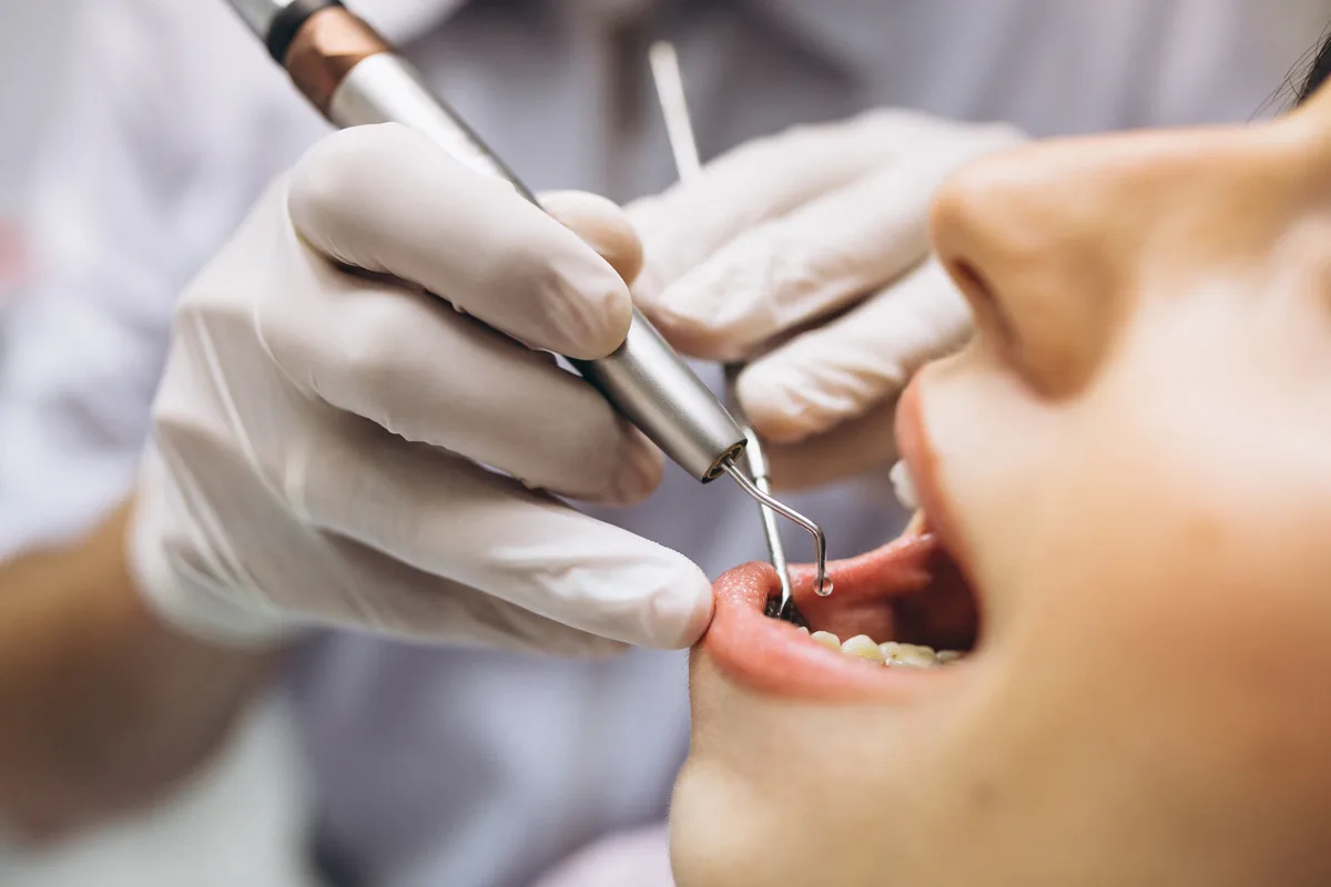 Acabamento manual da raspagem dental em Passos-MG