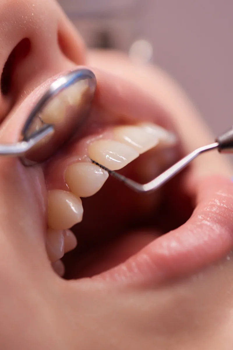 Raspagem subgengival periodontal em Passos-MG