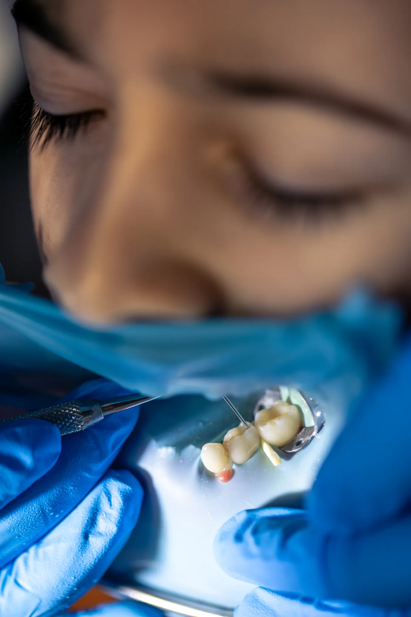 Restauração dentária em Passos-MG