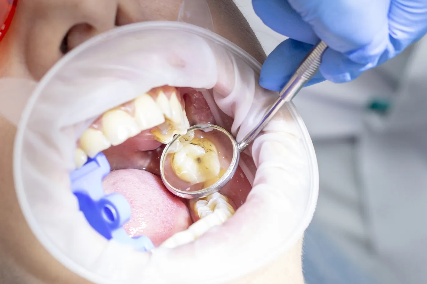 Substituição de restauração antiga por uma nova mais estética