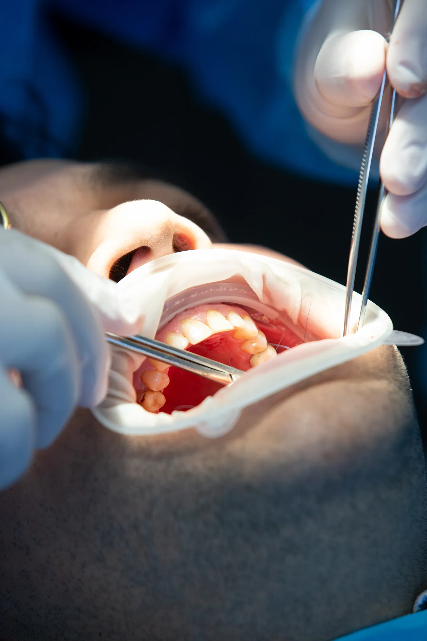 Tratamento de cárie e restauração do dente