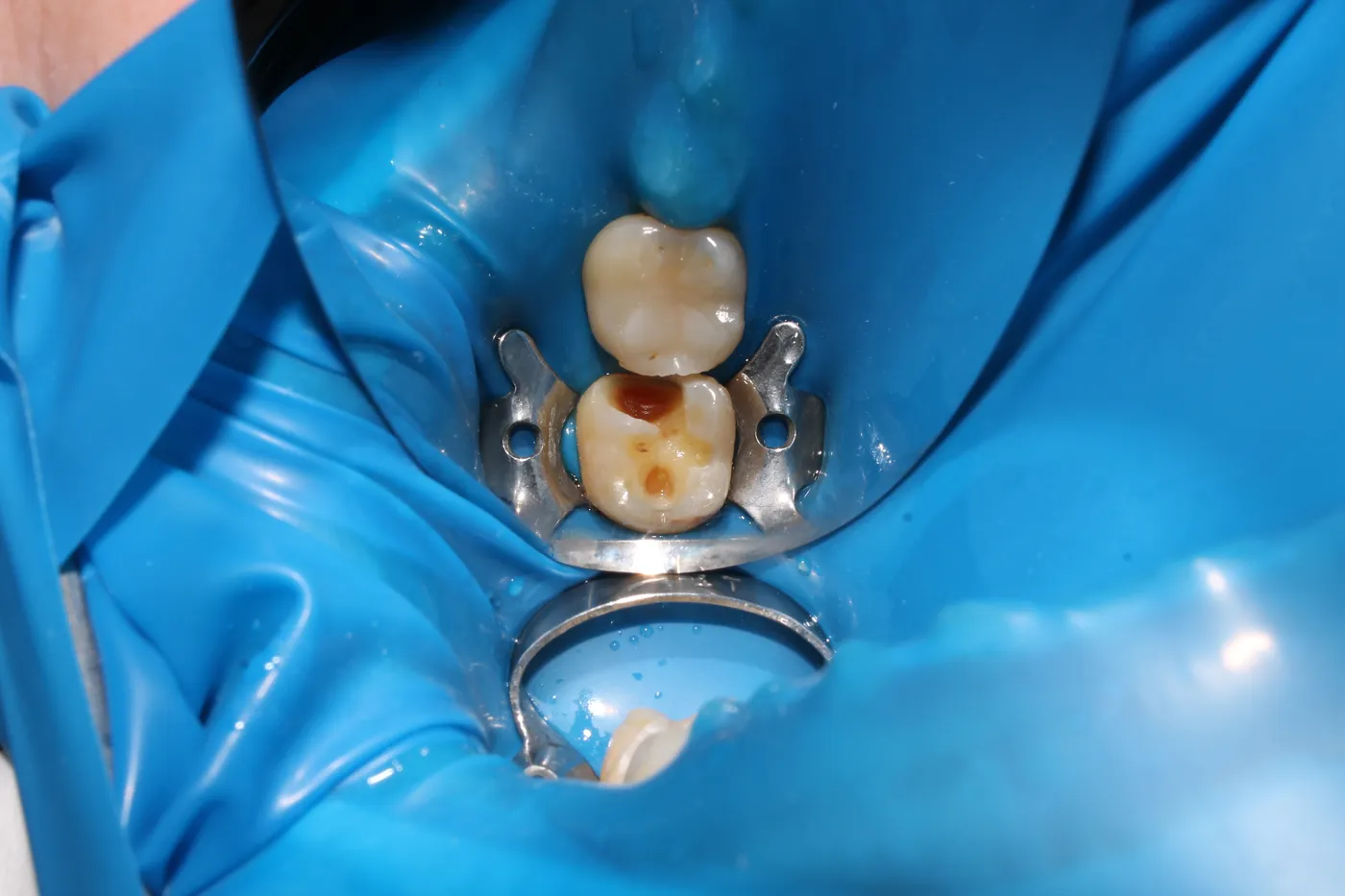Avaliação de sensibilidade dentária