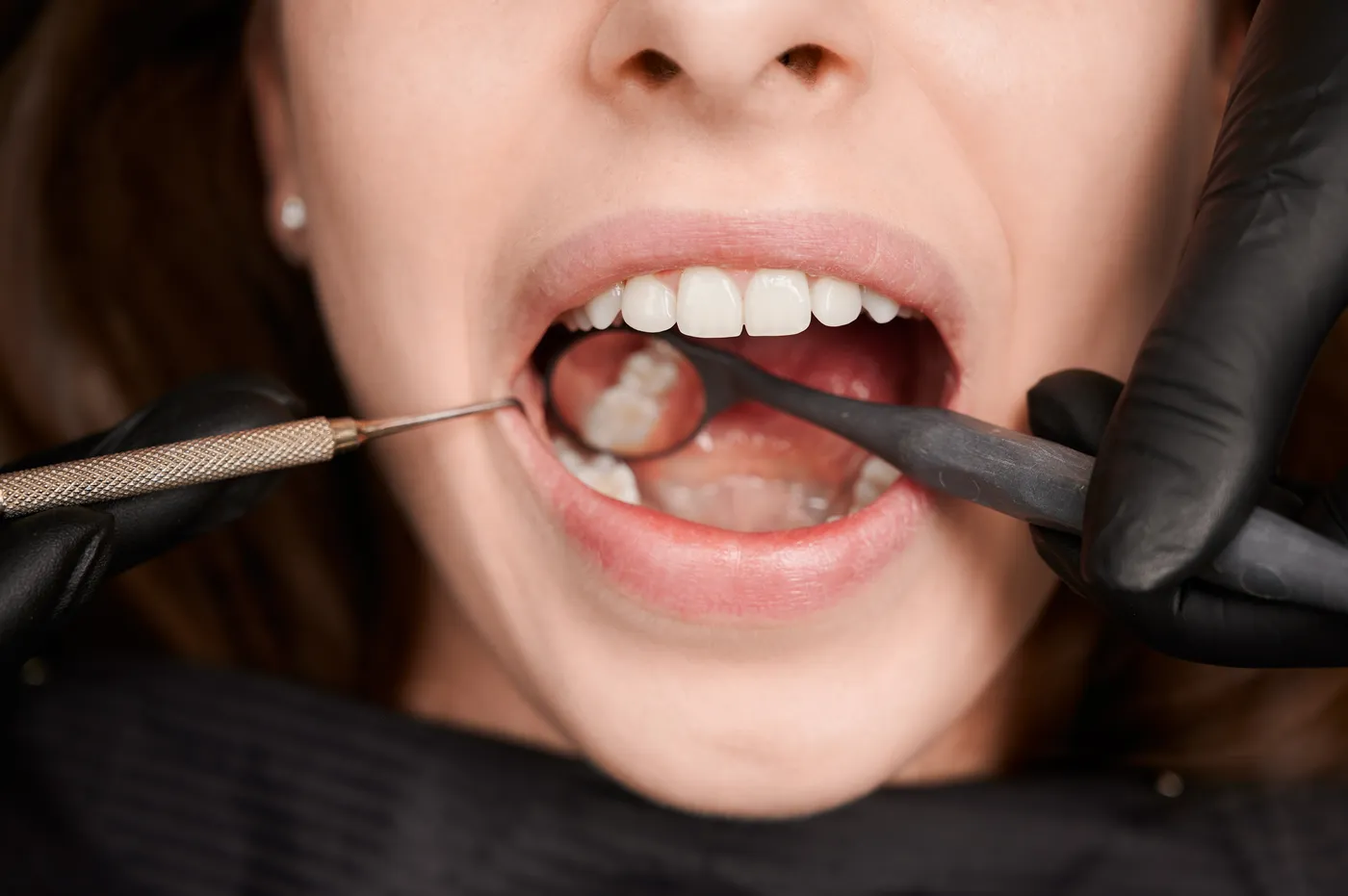 Restauração direta em resina composta sendo aplicada em dente posterior