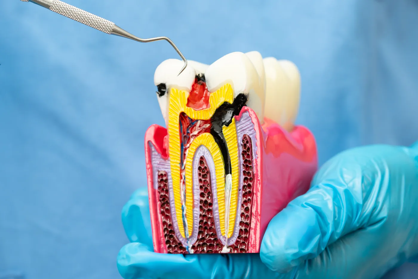 Dente escureceu depois do canal